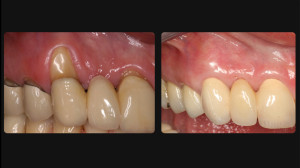 Befroe and after gum restoration
