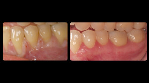 Before and after periodontal work - 4