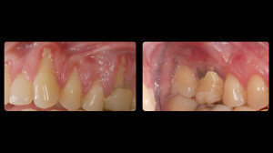 Before and after slides of periodontal work-5