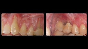 Before and after slides of periodontal work-5