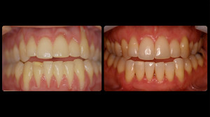 Before and after slides of periodontal work-6