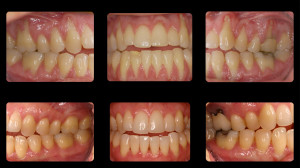 Before and after slides of periodontal work 7