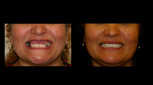 Before and After Top teeth replacement