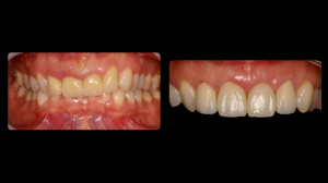 Before and after slides of top teeth