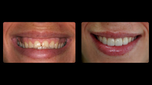 Before and after from periodontist Dr. Schrott