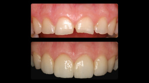 Before and after Top teeth were restored