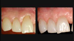 Before and after Periodontal work