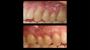 Before and after Periodontal work - 2