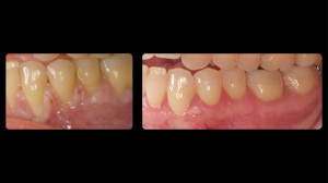 before and after periodontal work - 3