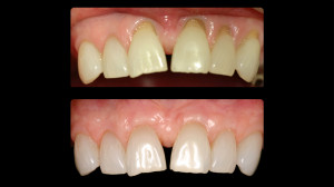 Before and after gum restoration