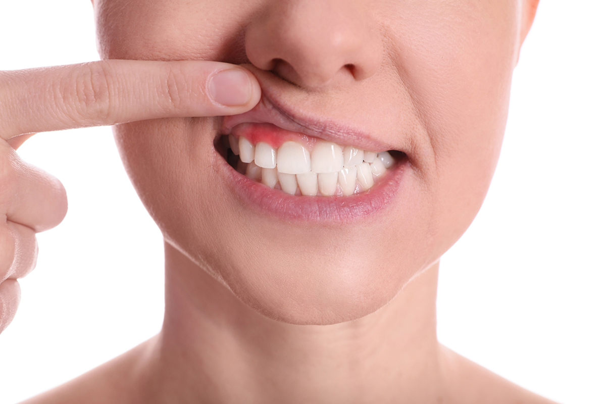 5 Early Warning Signs You May Need Non-Surgical Periodontal Therapy