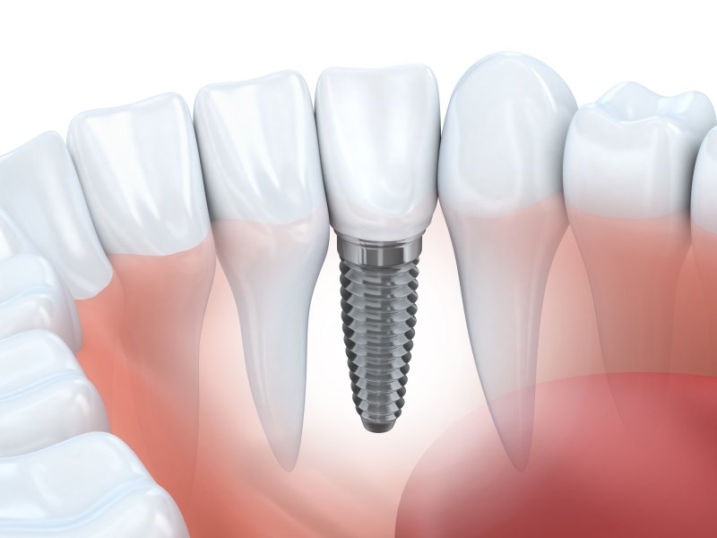 Render of titanium implants in jaw