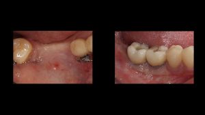 back dental implants before and after