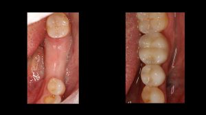 before and after images of dental implant in back of mouth