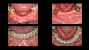 before and after images of multiple dental implants