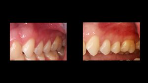 before and after pics of dental connective tissue on upper left