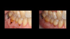 before and after image of rear connective tissue