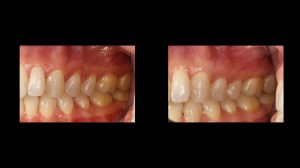 left side before and after image of dental connective tissue