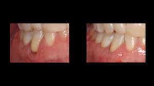 gum grafting before and after