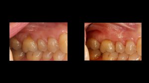 before and after pics of dental connective tissue on upper right