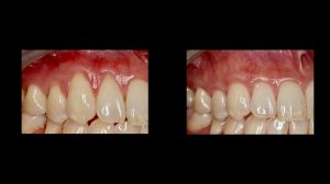 upper gum graft before and after image