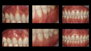 before and after photos of dental connective tissue