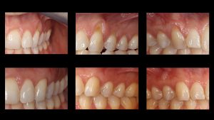 dental connective tissue before and after photos