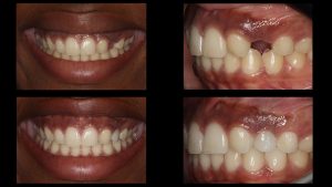 dental implant in top left upper