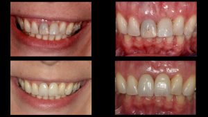 before and after pics of dental implants