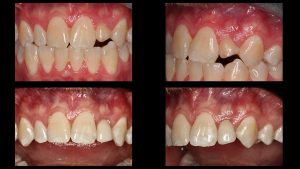 front left dental implant before and after