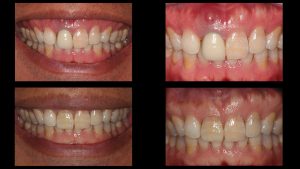 before and after image of front implant