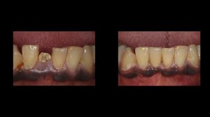 before and after image of lower front dental implant