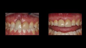 dental implants before and after