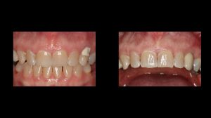 before and after cuspid implant