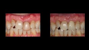 front tooth replacement