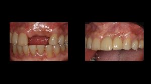 before and after of front teeth restored with dental implants