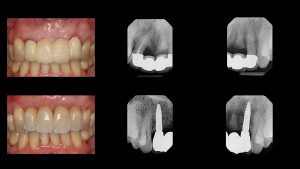 dental implants before and after with X-rays
