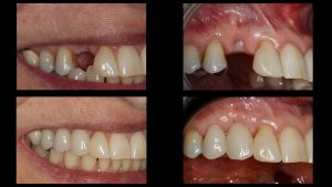 front right dental implant before and after
