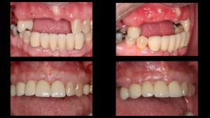 before and after front dental implant