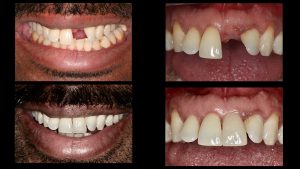 front left dental implant before and after