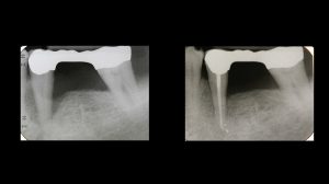 X-ray before and after of guided tissue regeneration