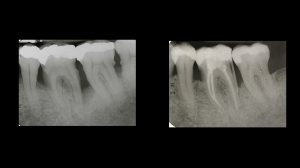X-rays of teeth showing guided tissue regeneration results
