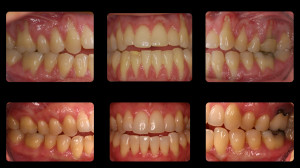 Before and after slides of periodontal work by Dr. Alexander Schrott