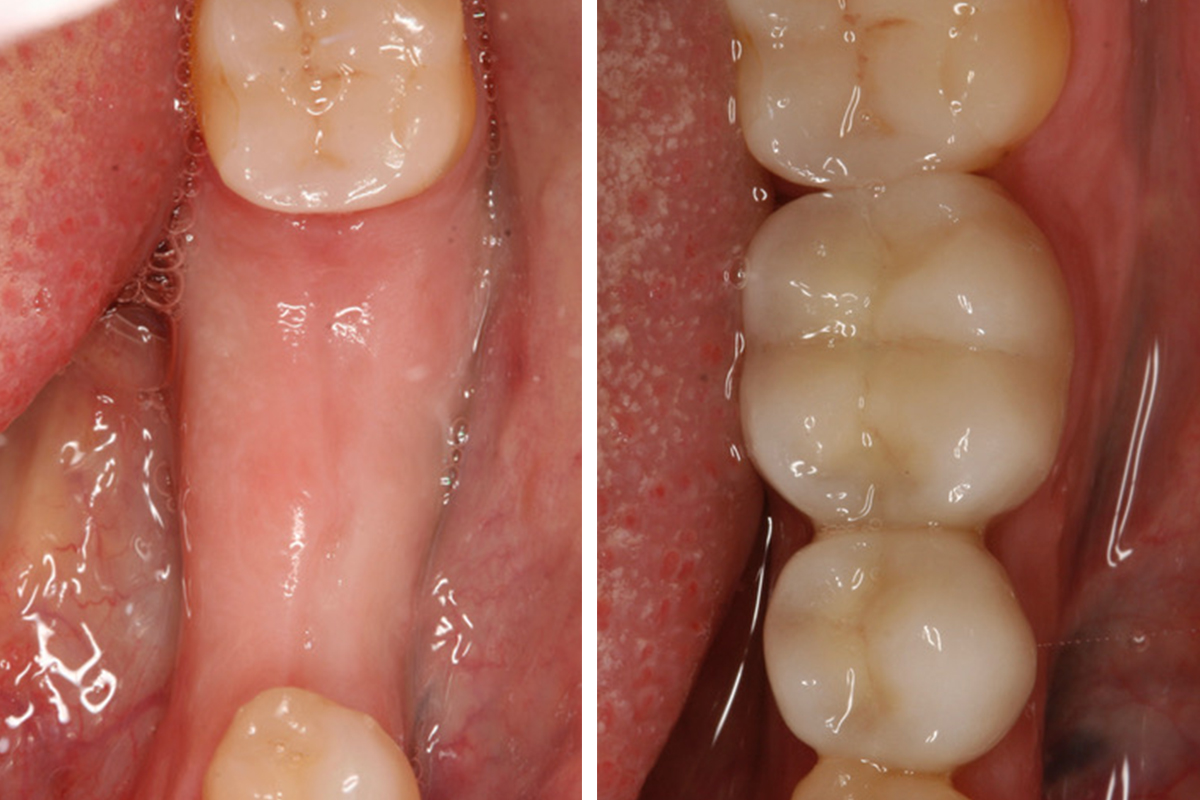 Am I a Candidate for Dental Implants?