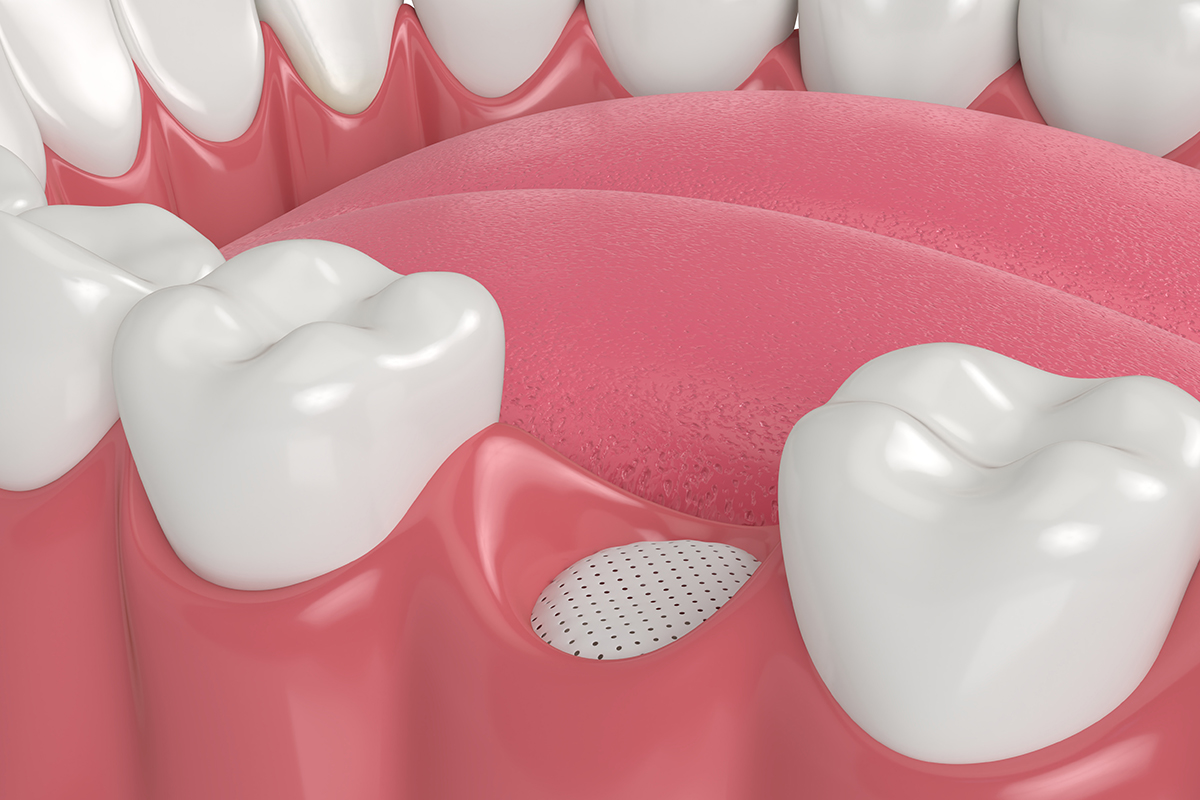 Can Bone Grafting Help Save Your Tooth?