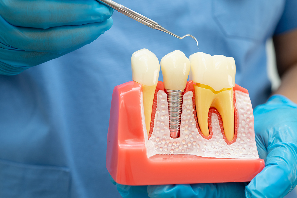 Can Smoking Affect Dental Implant Success? Here's What Patients in Belmont Should Know