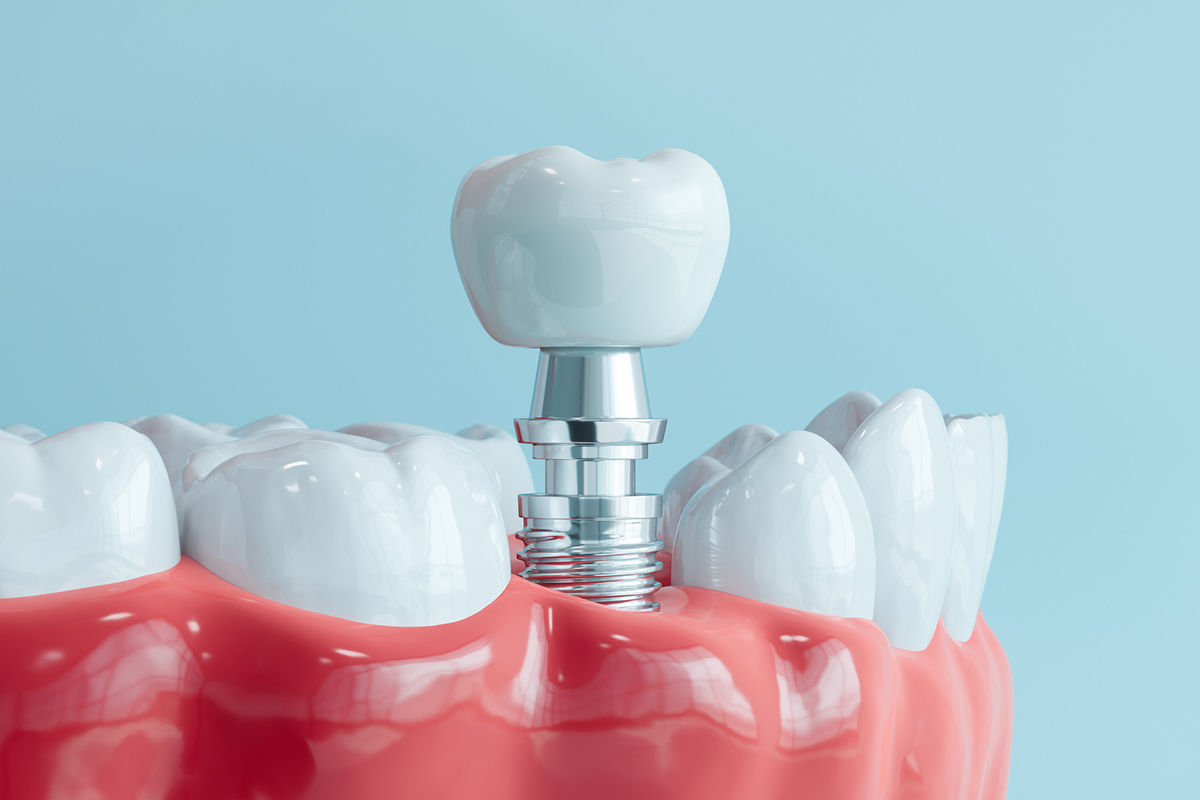 Dental Bone Graft vs Sinus Lift: Which One Do You Need for Implants?