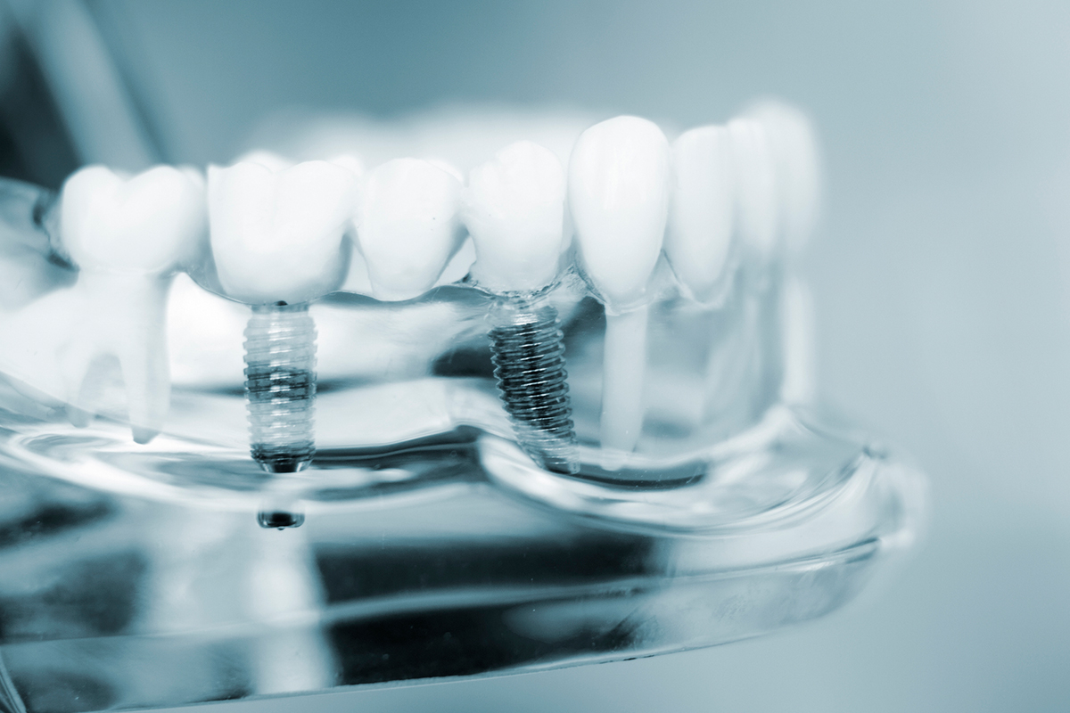 Dental Implants: Myths vs. Facts