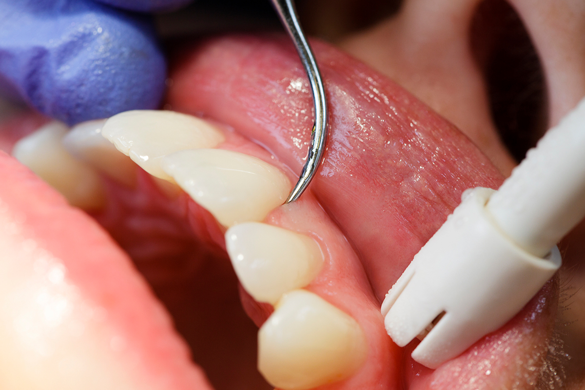 Flap Surgery for Gum Disease: What Belmont, MA Patients Should Know