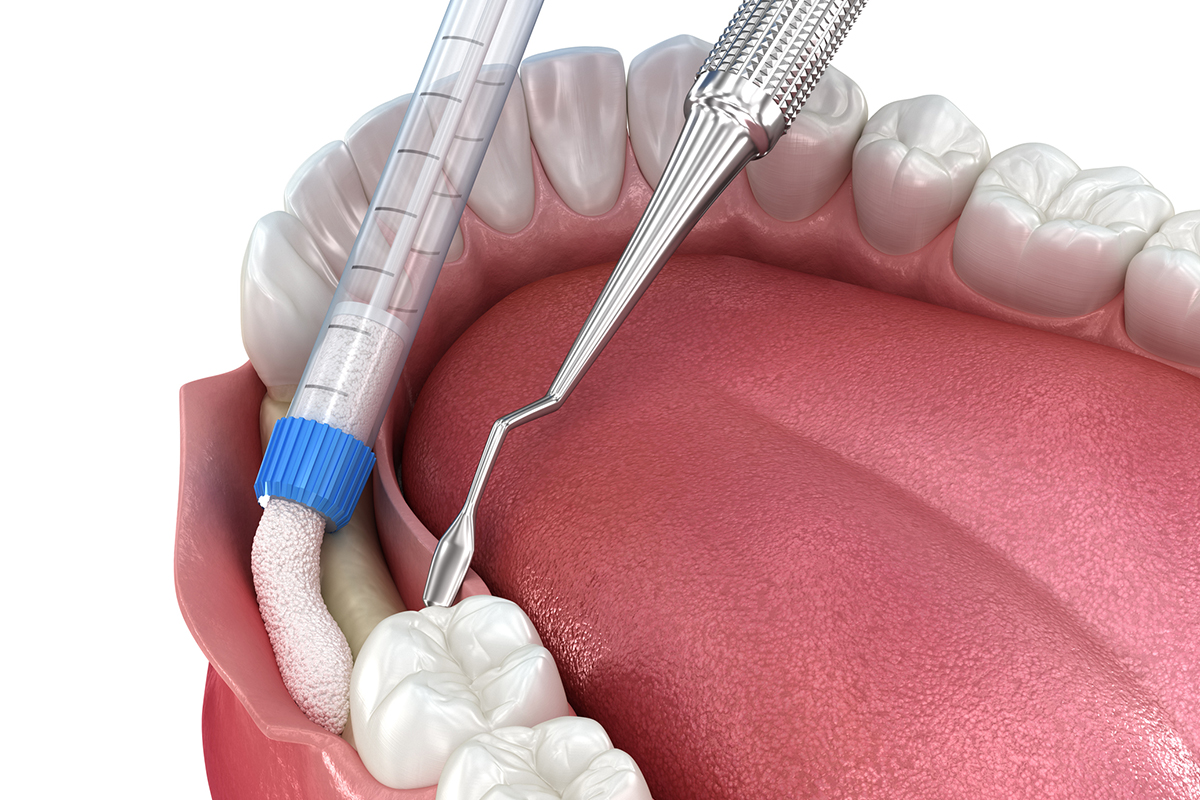 How Much Does Bone Grafting Cost In Belmont, MA?